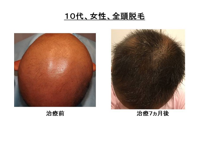円形脱毛症　病院""